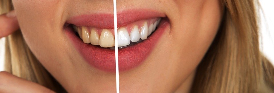 domowe sposoby na wybielenie zębów, jak wybielić zęby w domu, 